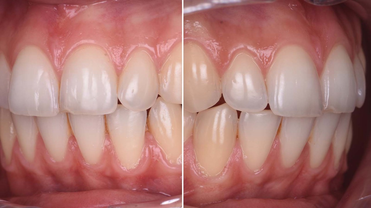 Lateral views of the initial situation.