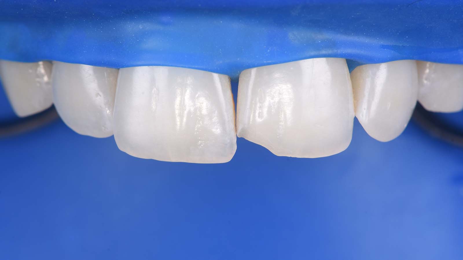 Removal of the old composite